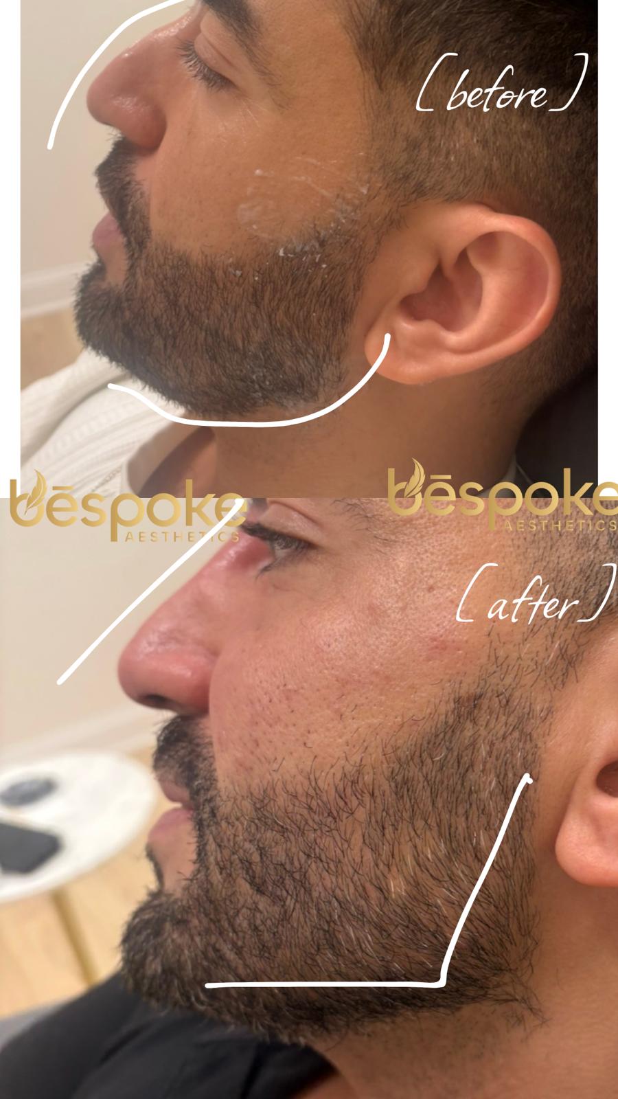 Biostimulator treatment before and after, jawline and lower face, Gainesville FL