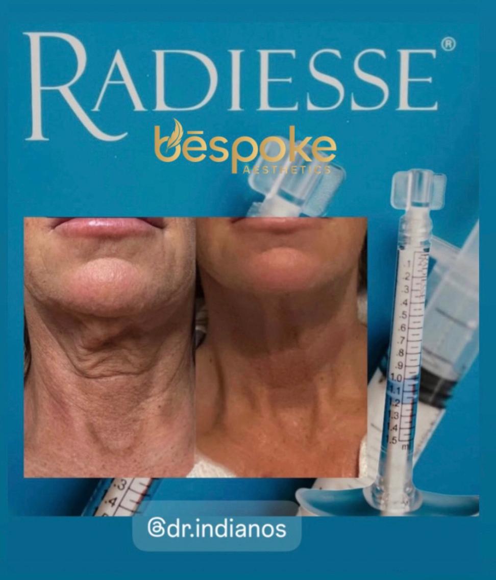 Collagen biostimulator before and after at Bespoke Aesthetics Gainesville FL