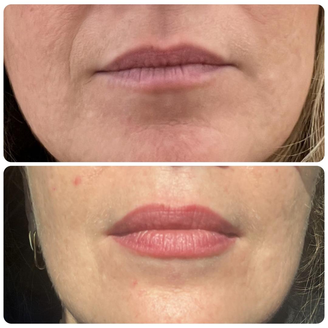 Dermal filler before and after, lower face, Bespoke Aesthetics Gainesville FL