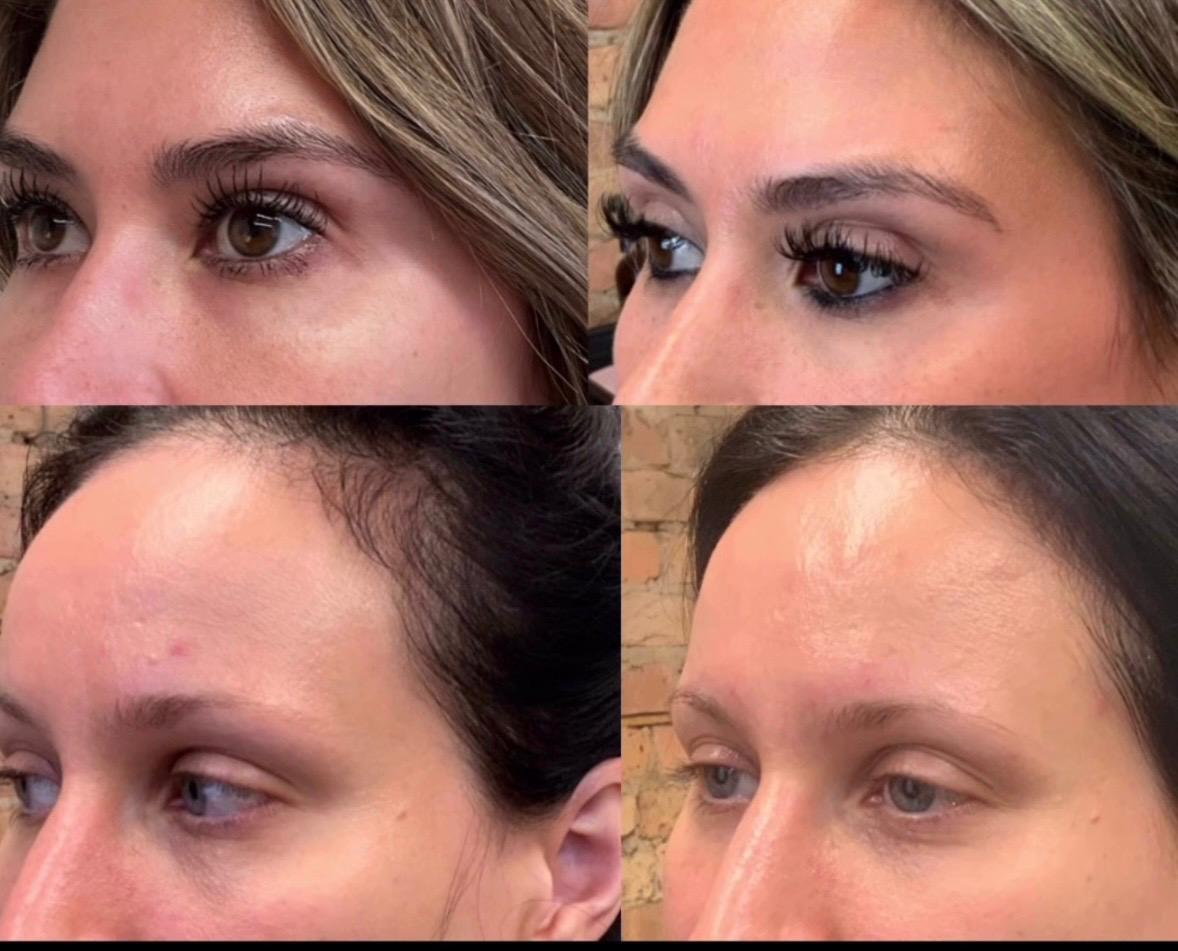 Under eye filler before and after at Bespoke Aesthetics, Gainesville Florida