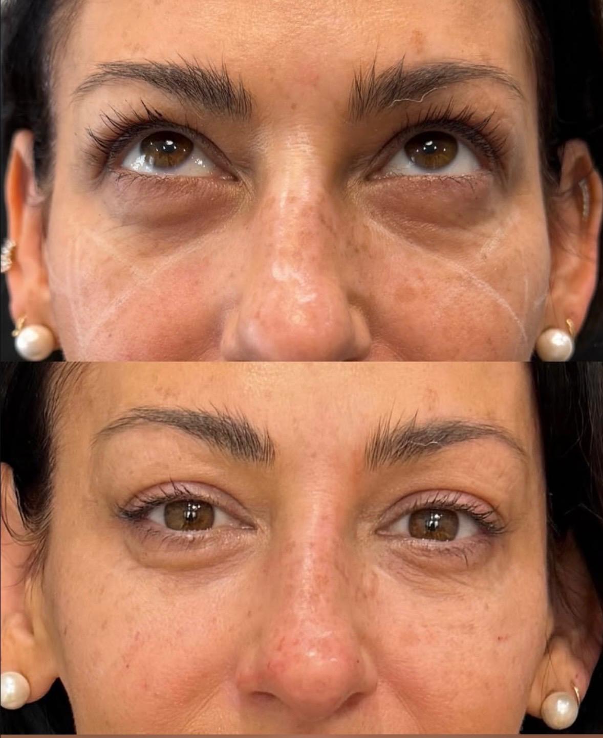 Tear trough filler before and after, physician administered, Gainesville FL