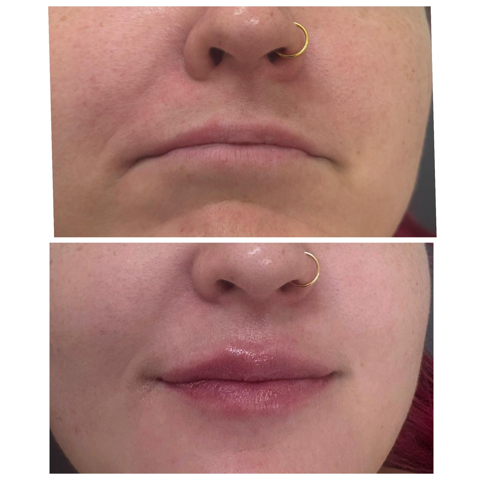 Nasolabial fold filler before and after, Bespoke Aesthetics Gainesville