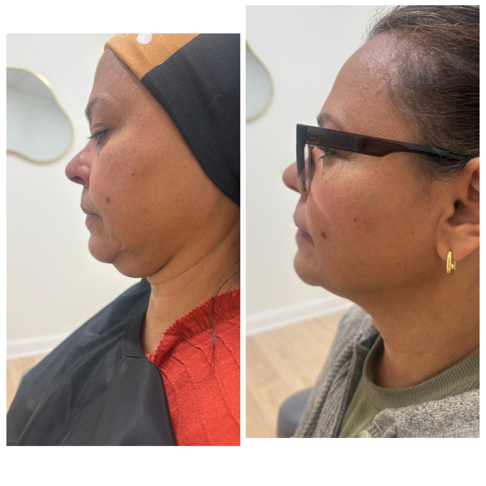 Jawline and profile filler before and after, Bespoke Aesthetics Gainesville FL