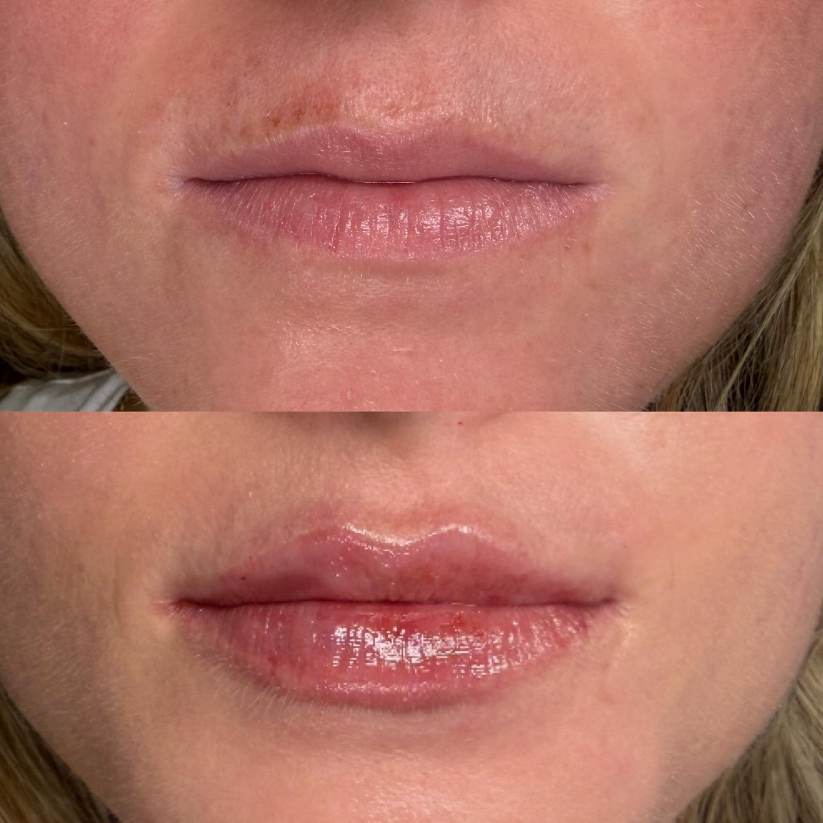 Before and after lip filler at Bespoke Aesthetics in Gainesville, Florida