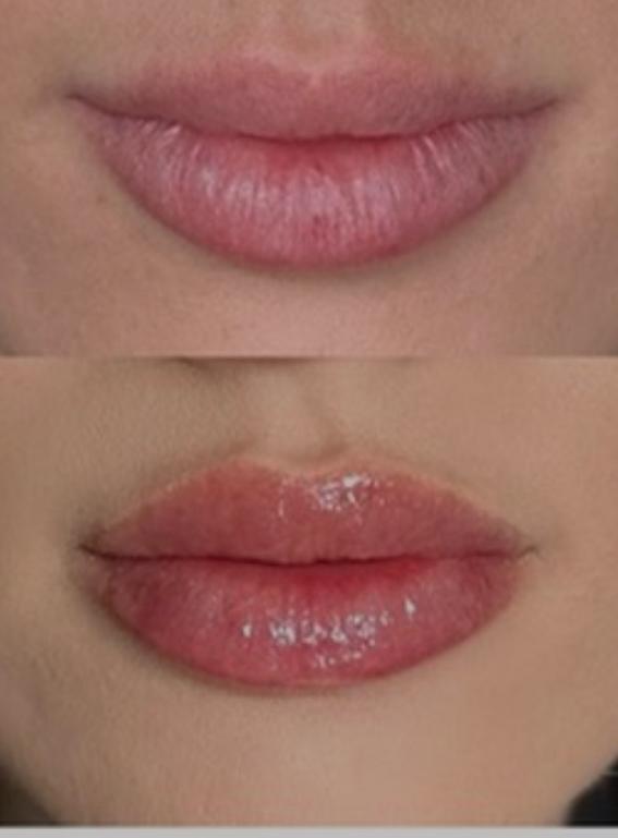 Lip filler before and after photo, Bespoke Aesthetics Gainesville FL