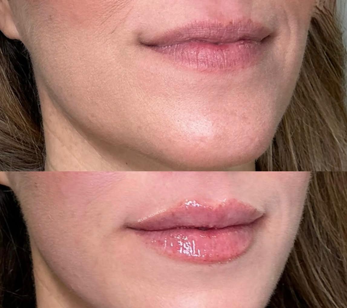 Lip enhancement before and after, physician administered, Gainesville FL