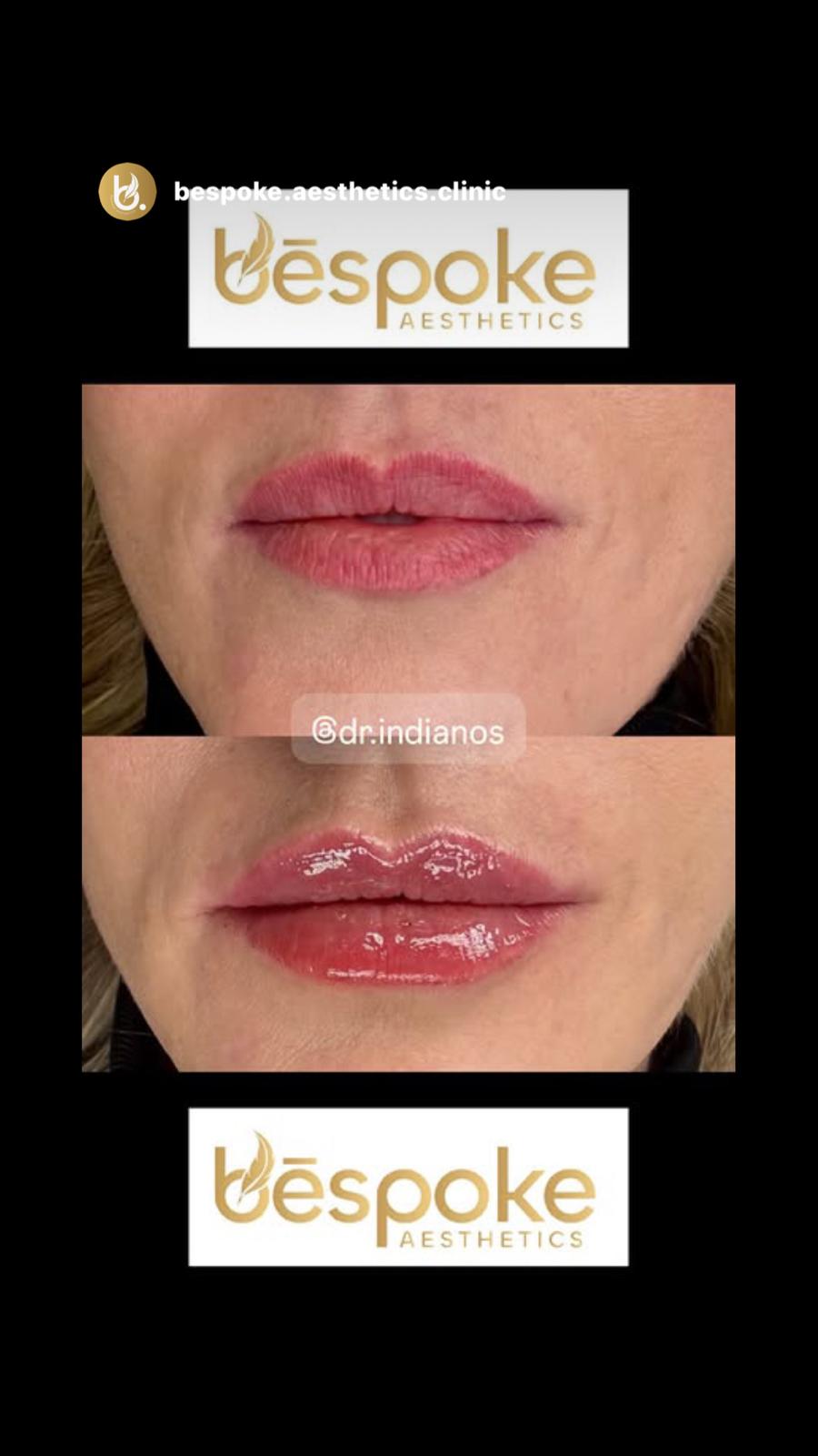 Lip filler result at Bespoke Aesthetics, before and after comparison
