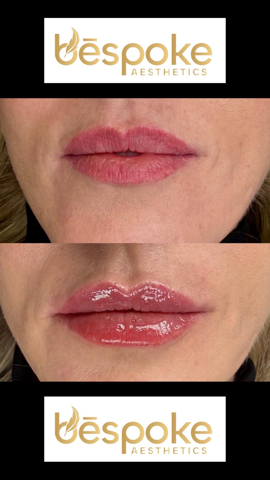 Before and after lip filler treatment, Bespoke Aesthetics Gainesville