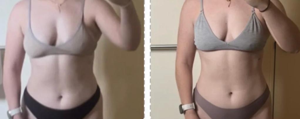 Physician supervised weight loss progress photos, Gainesville FL