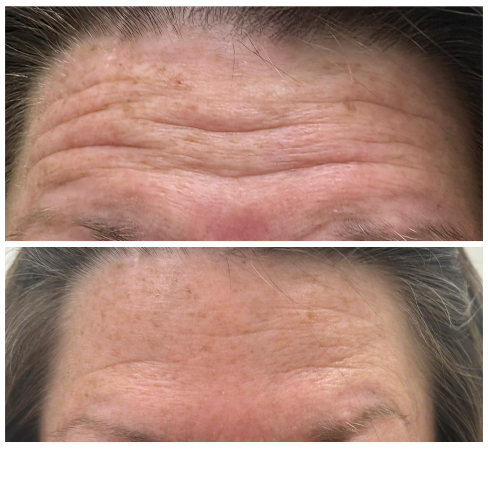 Forehead lines before and after wrinkle relaxer treatment, Gainesville FL