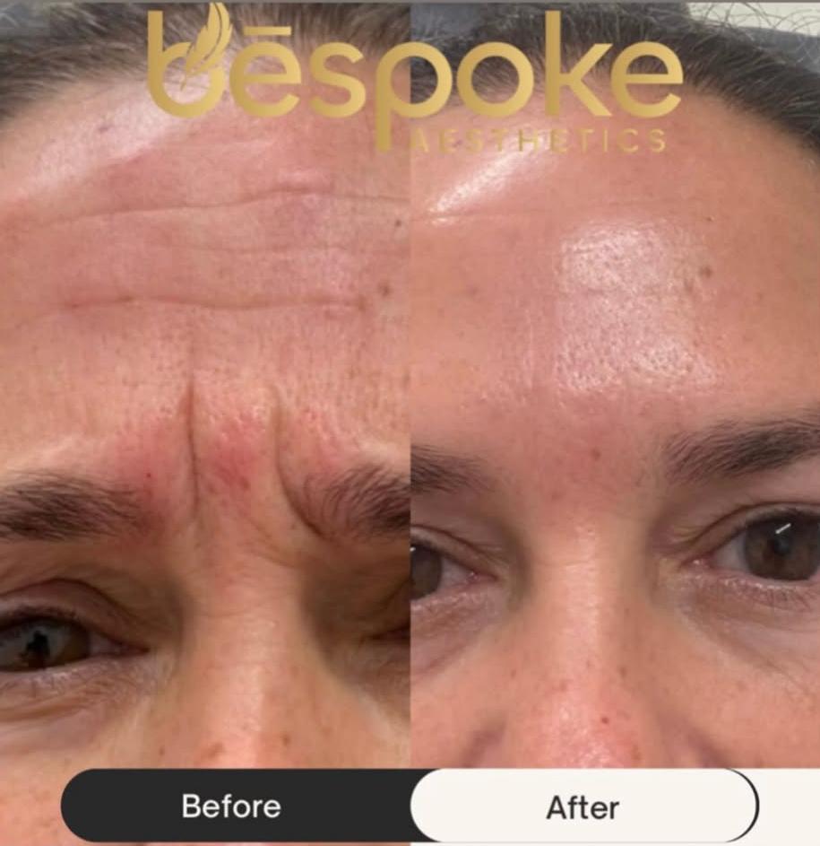 Before and after neuromodulator treatment at Bespoke Aesthetics Gainesville